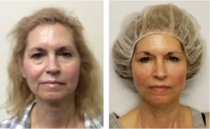 NON-SURGICAL FACELIFT FARMINGTON CT