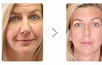 Non Surgical Facelift Glastonbury CT